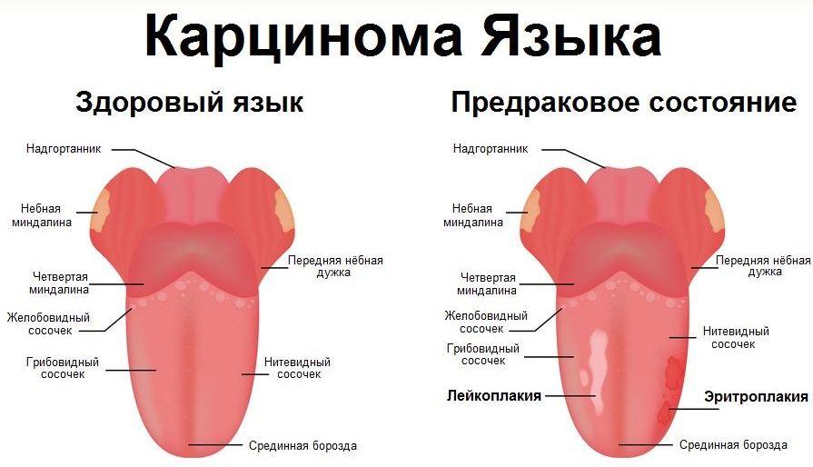 Увеличение языка