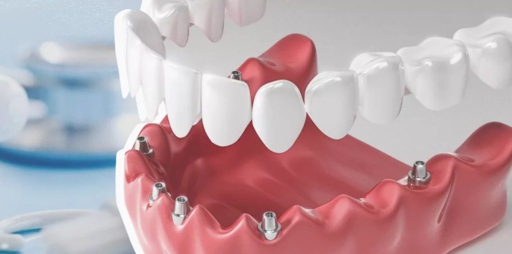Імплантація  All-on-4 і All-on-6 для заміни втрачених зубів
