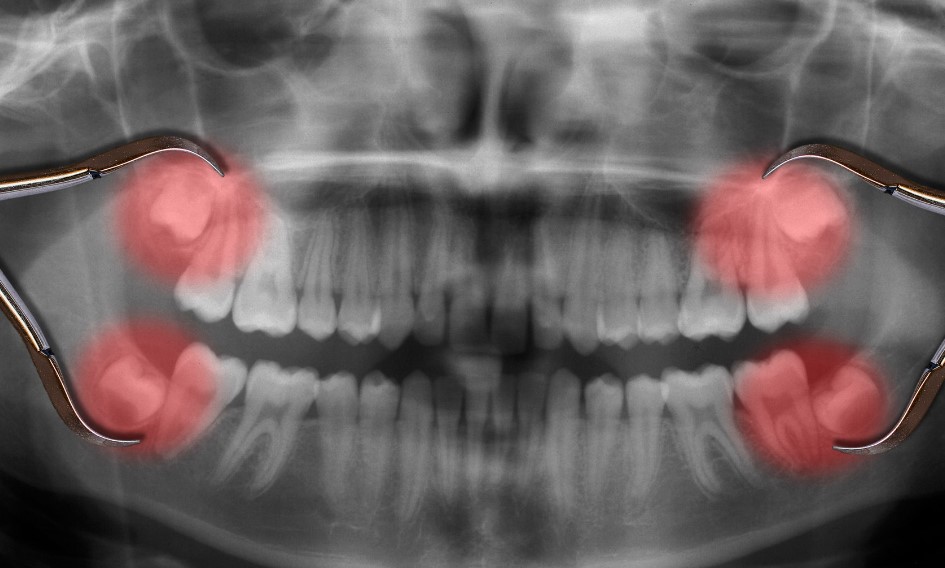 Діагностика перед видаленням зуба мудрості