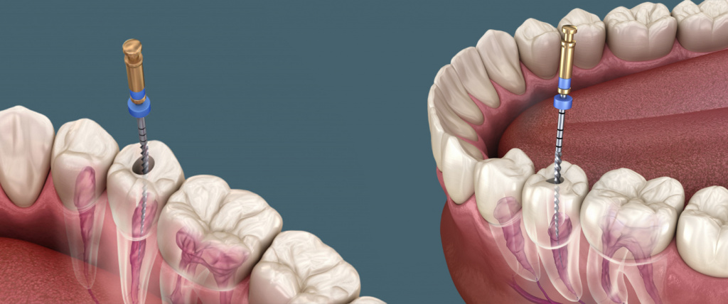 Переваги лікування зубів під мікроскопом